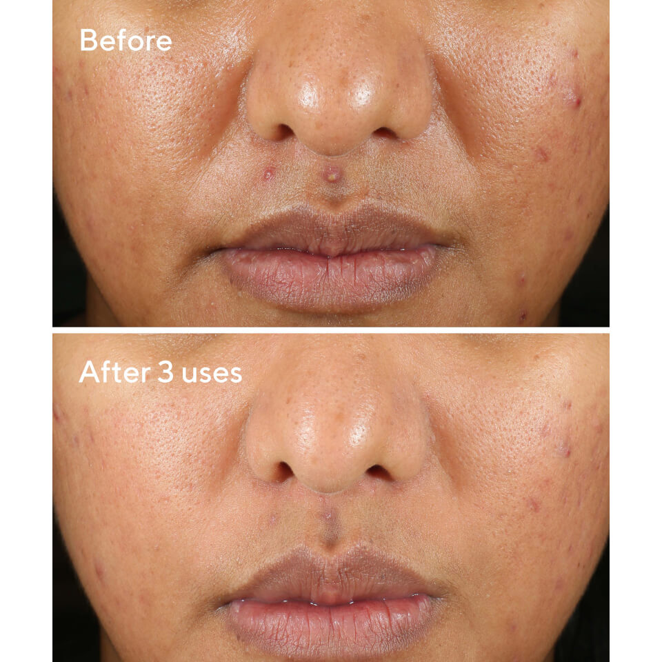 Rapid Relief Sulphur Mask