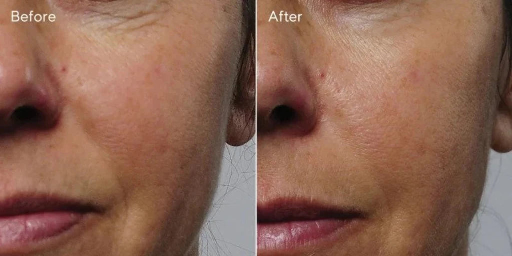 Rapid Collagen Infusion